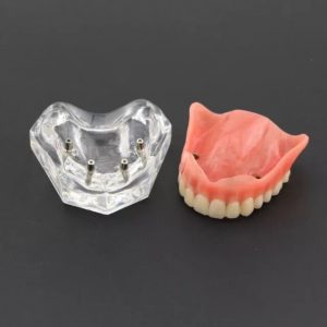Healix 4 Implant Denture Model